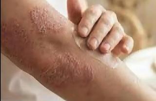 Minsa orienta sobre la psoriasis: reconocer las lesiones y buscar atención médica oportuna es clave