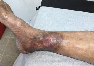 Clínica de heridas en Chilibre, un alivio para los pacientes