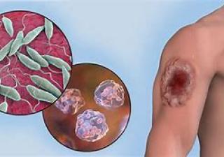 Leishmaniasis enfermedad cutánea ocasionada por picadura de un mosquito infectado 