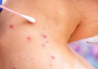  MINSA se mantendrá en vigilancia epidemiológica por la emergencia de salud pública de la viruela del mono