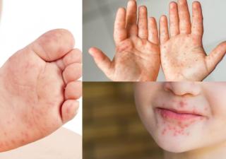  Recomendaciones ante la enfermedad viral boca, manos, pies