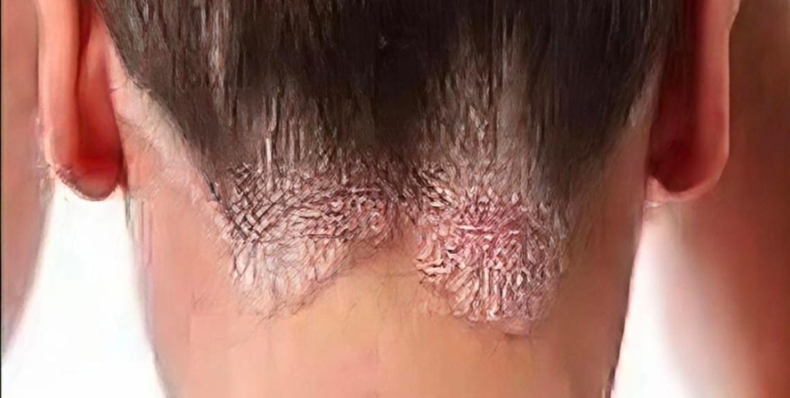 Minsa orienta sobre la psoriasis: reconocer las lesiones y buscar atención médica oportuna es clave