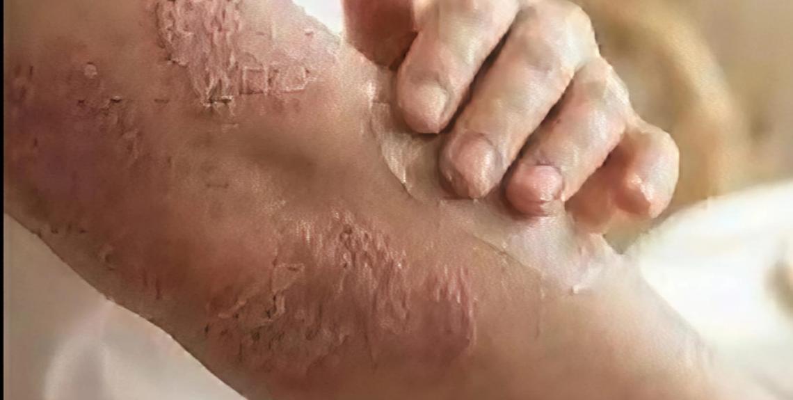 Minsa orienta sobre la psoriasis: reconocer las lesiones y buscar atención médica oportuna es clave